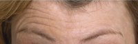 Botox Forehead